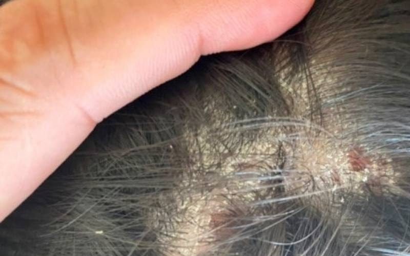 Nấm da đầu: Nguyên nhân, dấu hiệu và cách điều trị hiệu quả